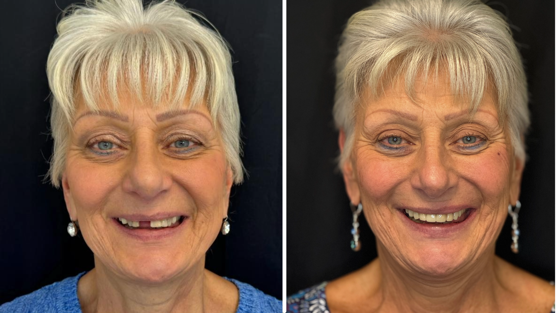 dental implant patient photo