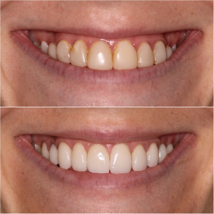 porcelain veneers